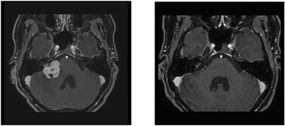 Facial Nerve Function After Microsurgical Resection in Vestibular Schwannoma Under Neurophysiological Monitoring